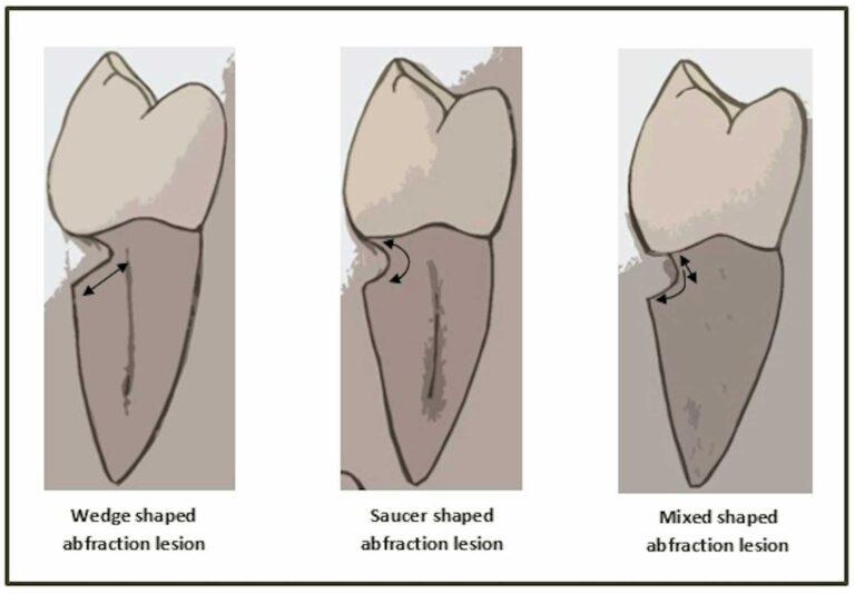 ‘Toothpick grooves’ in ancient fossil human teeth may not be from toothpicks after all